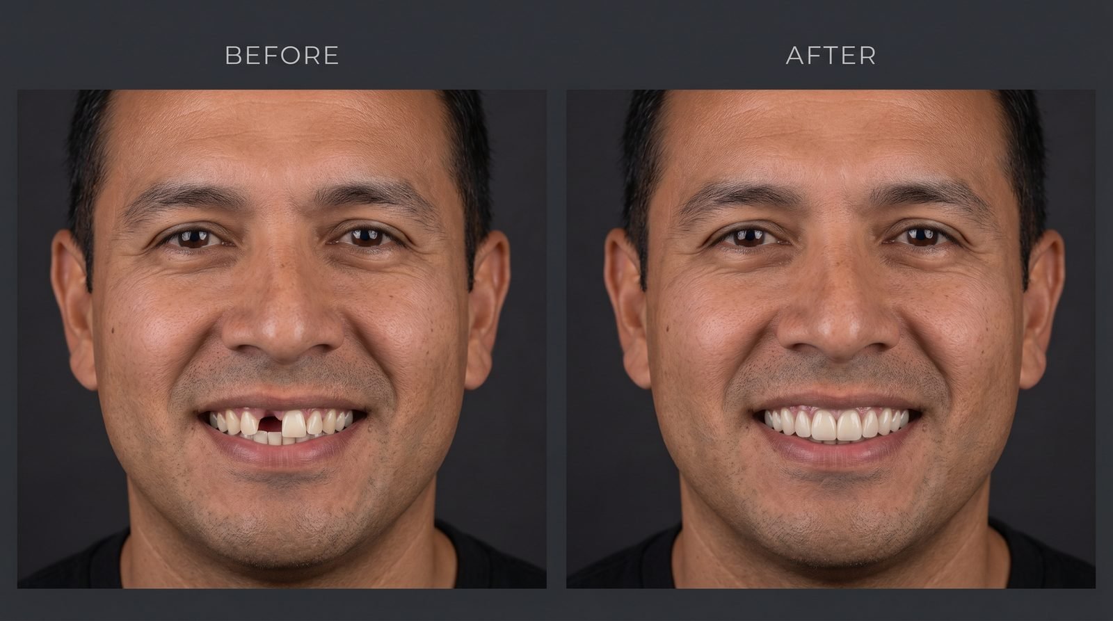 Antes e depois de um tratamento de implante dentário mostrando um sorriso restaurado com um dente da frente substituído