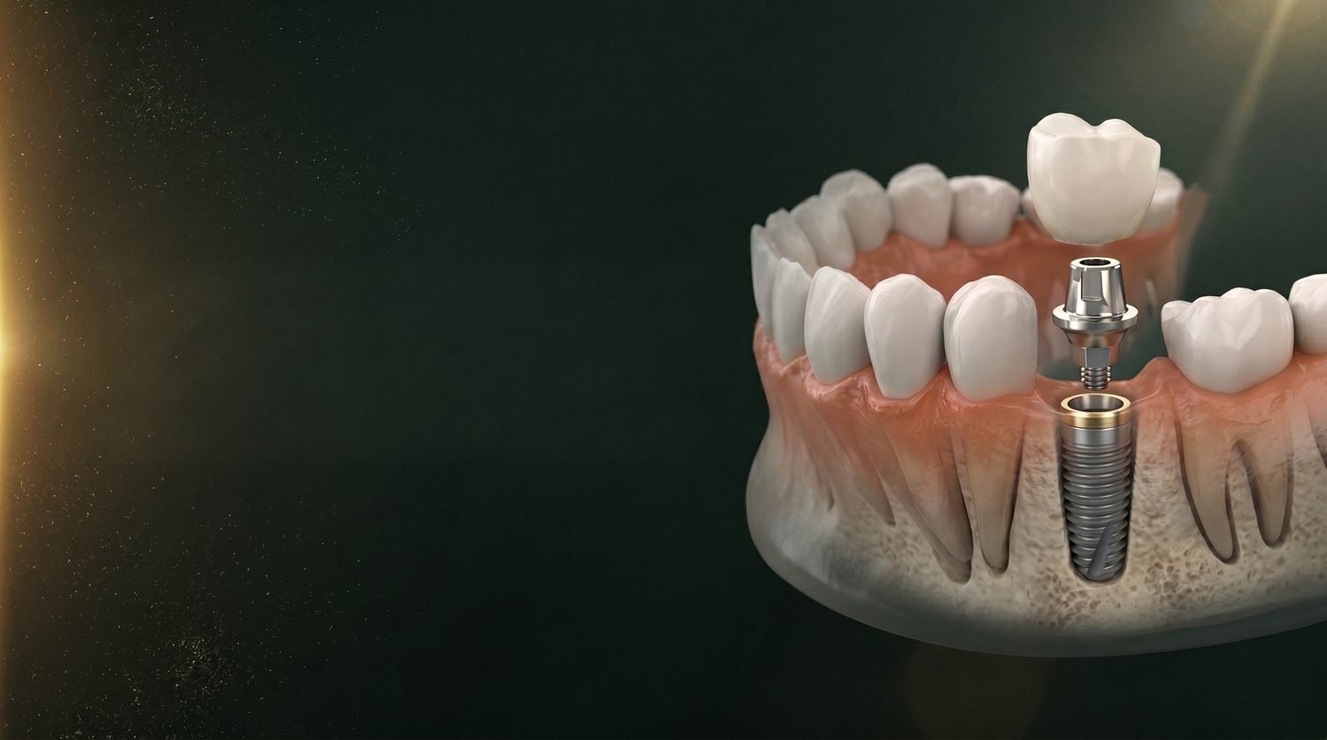 Ilustração em corte de um implante dentário colocado no osso, com coroa e pilar